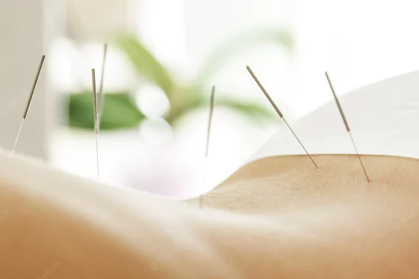 Acupuncture Treatment
